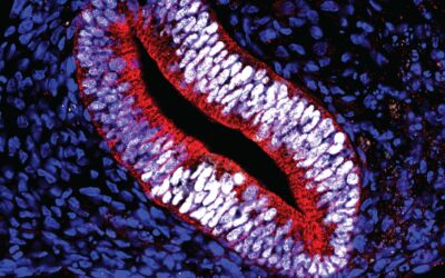 Published Research Study: AAV-mediated exon skipping therapy for Usher syndrome, type 2A