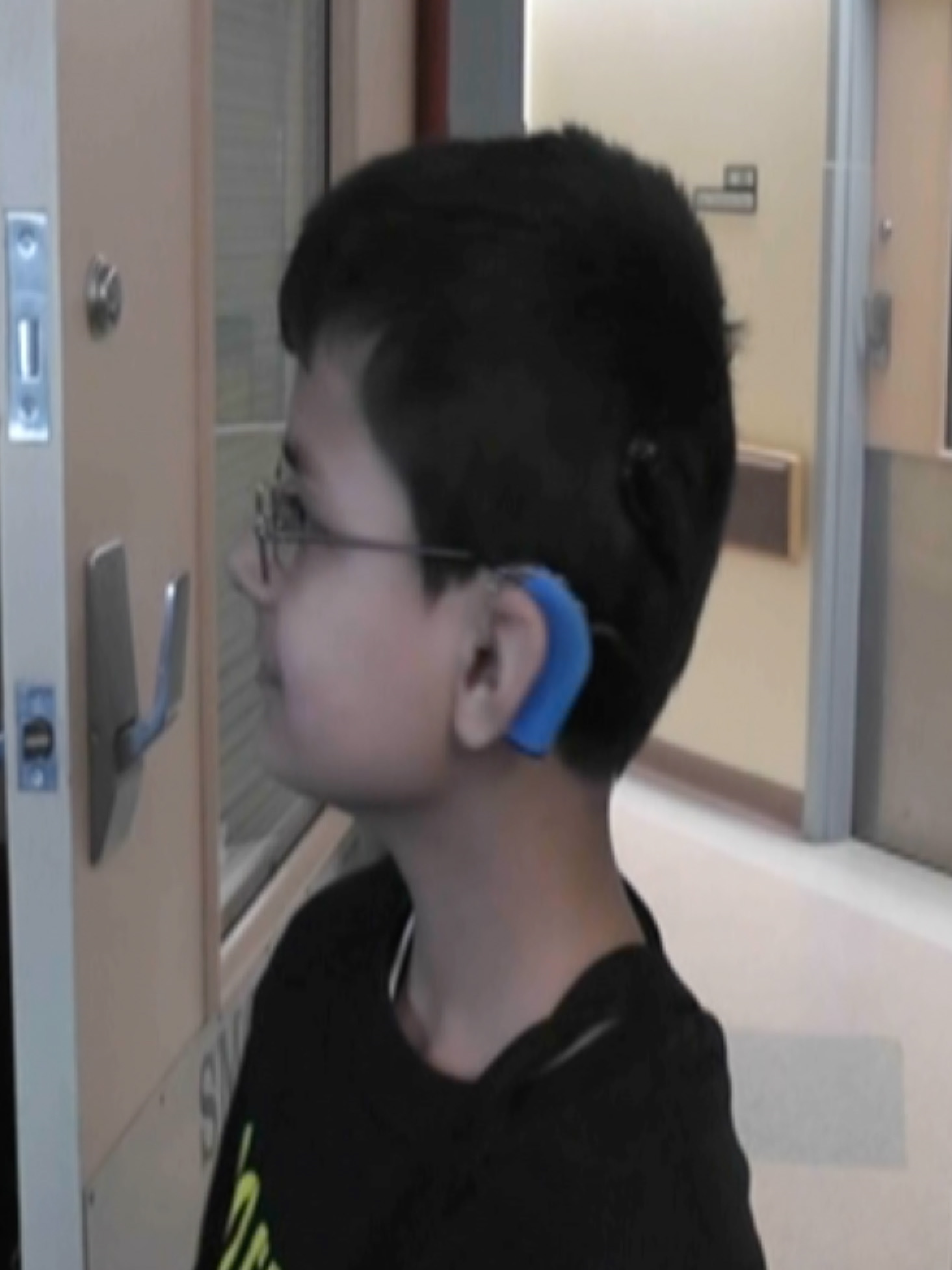Awais showing his left side cochlear implant after activation.